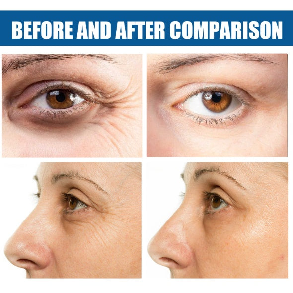 Collagen lift eye patches- Dark Circle Treatment (highly recommend)